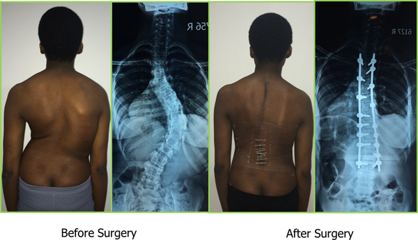 Scoliosis