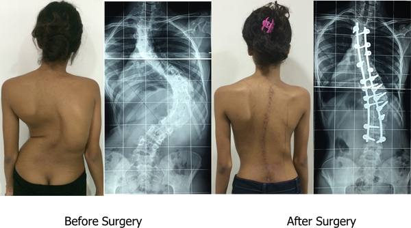 Scoliosis