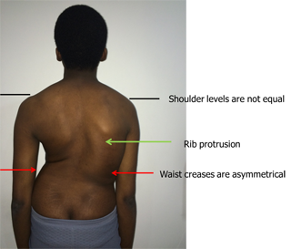 Scoliosis